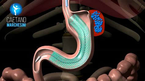 gastric sleeve leak|Endoscopic Management of Laparoscopic Gastric Sleeve Leaks